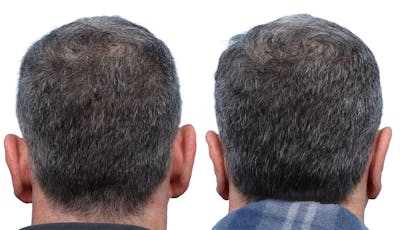 Otoplasty (Ear Surgery) Before & After Gallery - Patient 126952 - Image 1