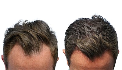 FUE Hair Transplant Before & After Gallery - Patient 324840 - Image 1