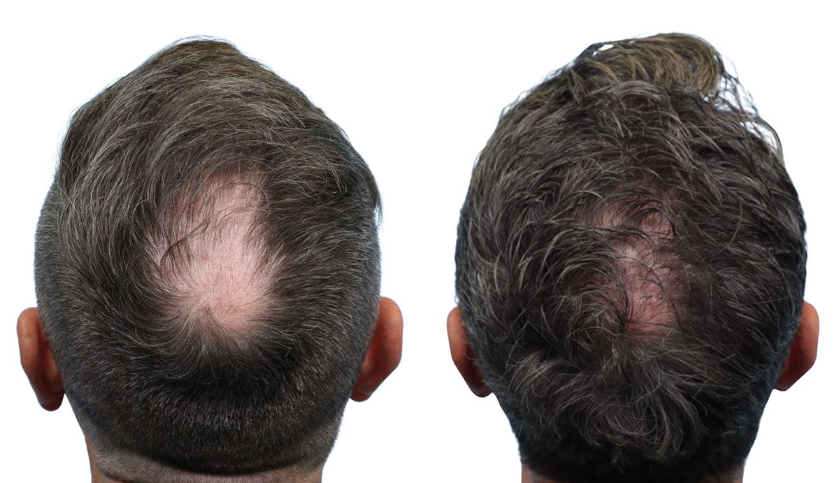 FUE Hair Transplant Before & After Gallery - Patient 324840 - Image 2