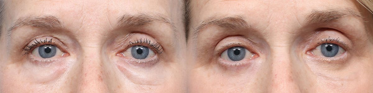 Blepharoplasty (Eyelid Surgery) Before & After Gallery - Patient 981259 - Image 1
