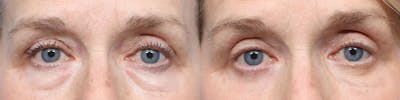 Blepharoplasty (Eyelid Surgery) Before & After Gallery - Patient 981259 - Image 1