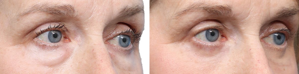 Blepharoplasty (Eyelid Surgery) Before & After Gallery - Patient 981259 - Image 2