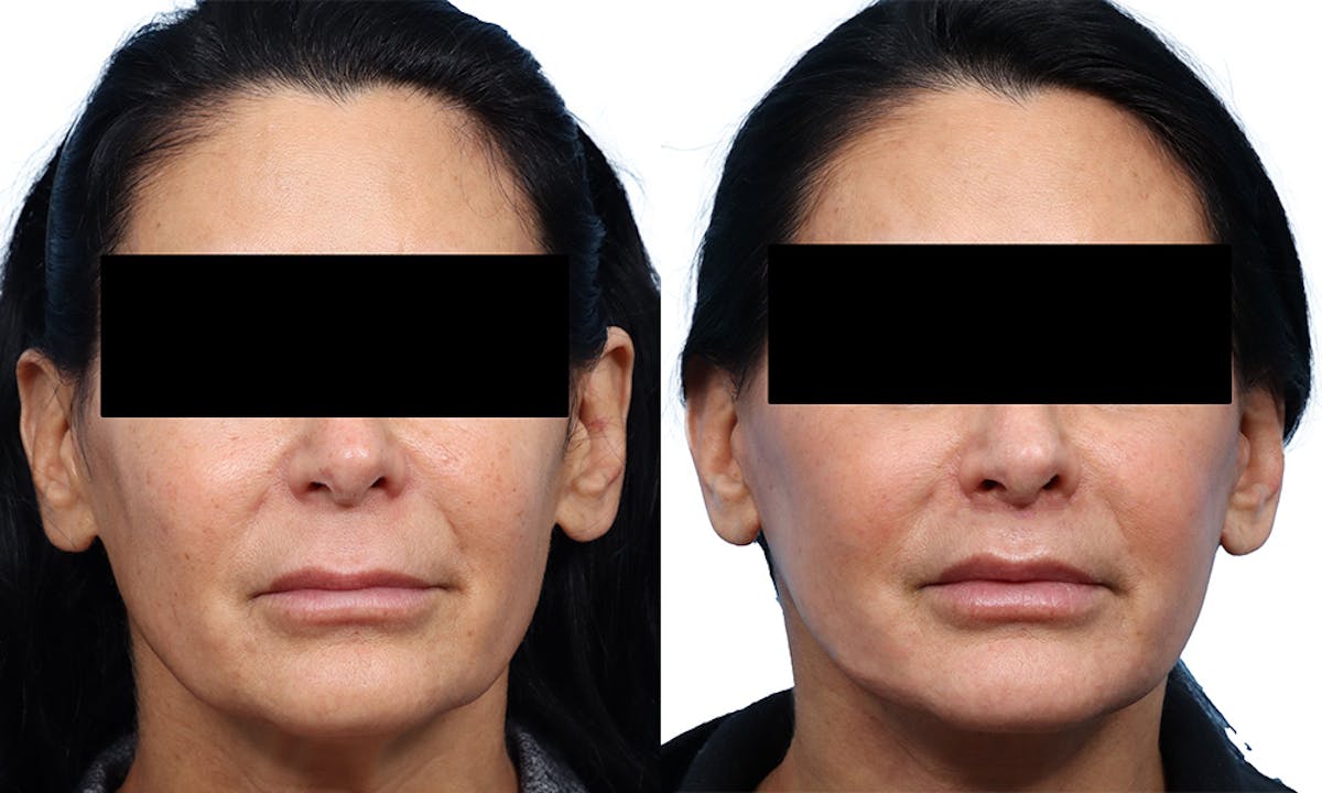 Deep Plane Facelift Before & After Gallery - Patient 364522 - Image 1