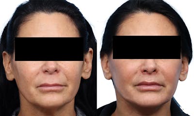 Deep Plane Facelift Before & After Gallery - Patient 364522 - Image 1