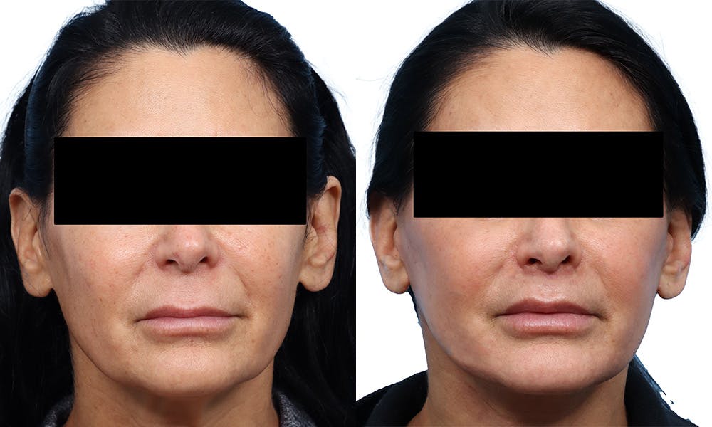 Lip Lift Before & After Gallery - Patient 358690 - Image 1