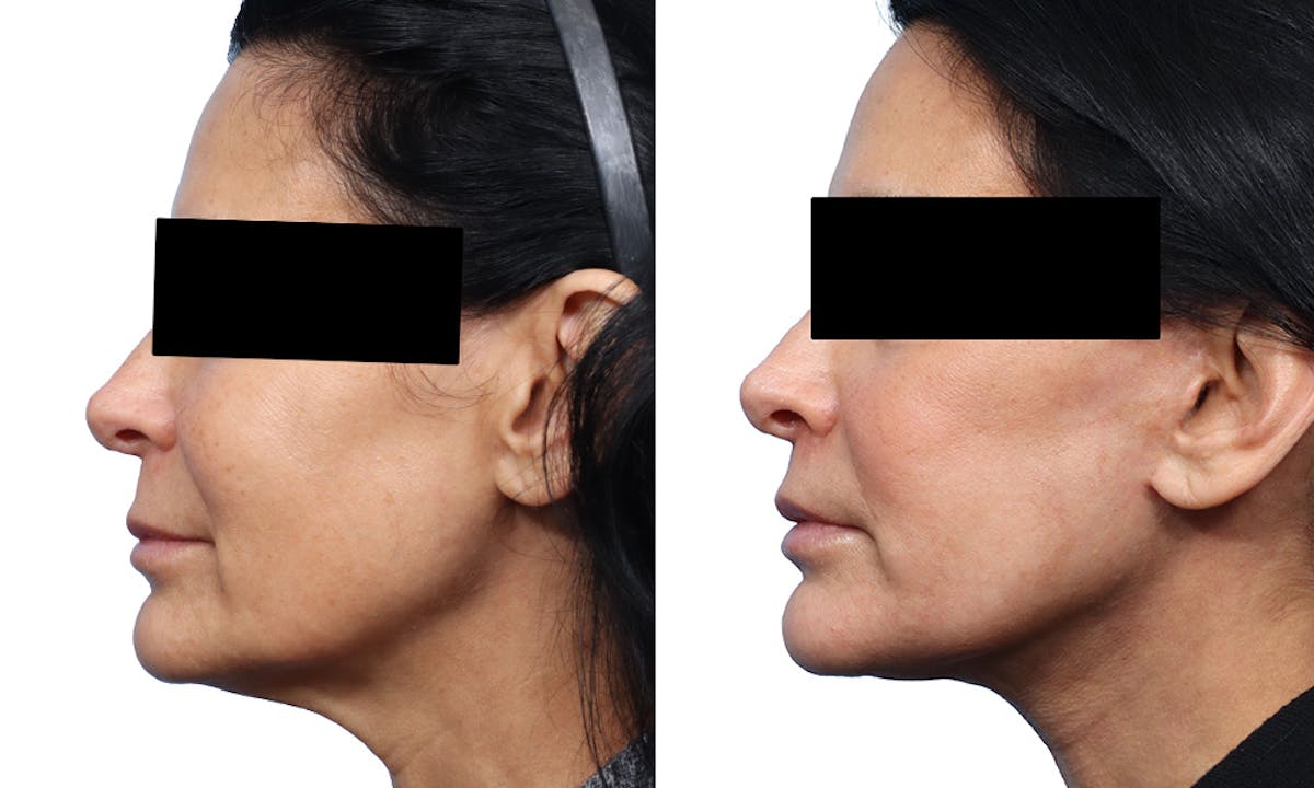Deep Plane Facelift Before & After Gallery - Patient 364522 - Image 2