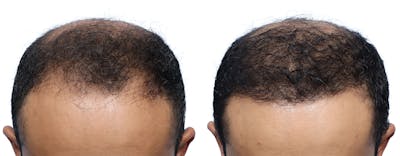 FUE Hair Transplant Before & After Gallery - Patient 428328 - Image 1