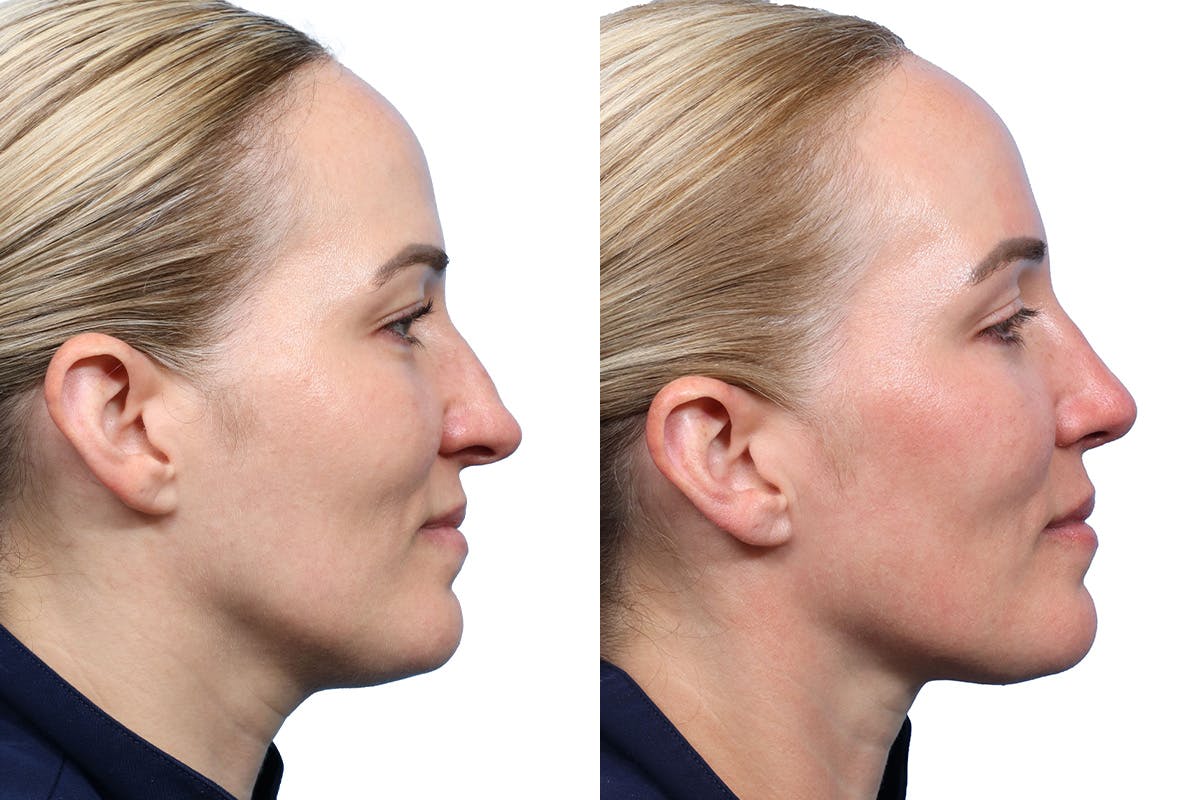 Rhinoplasty Before & After Gallery - Patient 377244 - Image 1