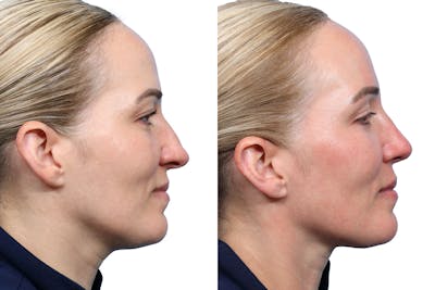 Rhinoplasty Before & After Gallery - Patient 377244 - Image 1