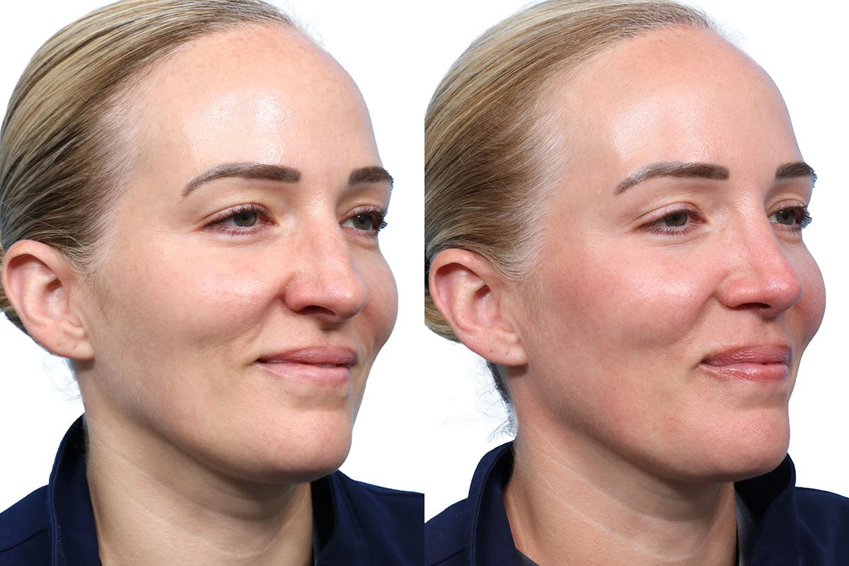 Rhinoplasty Before & After Gallery - Patient 377244 - Image 2