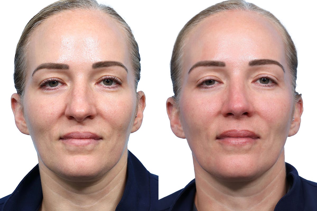 Rhinoplasty Before & After Gallery - Patient 377244 - Image 3