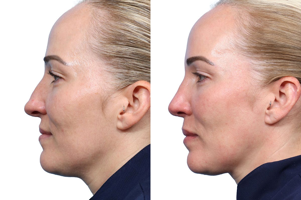 Rhinoplasty Before & After Gallery - Patient 377244 - Image 4