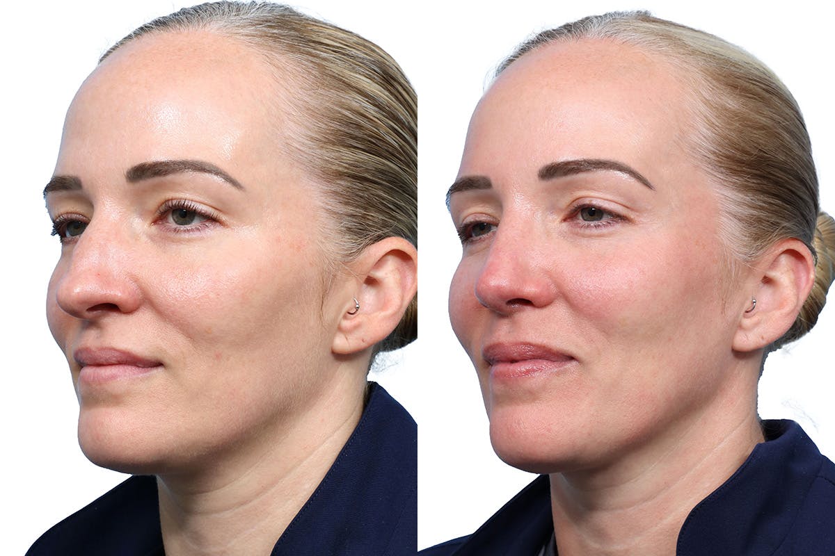 Rhinoplasty Before & After Gallery - Patient 377244 - Image 5