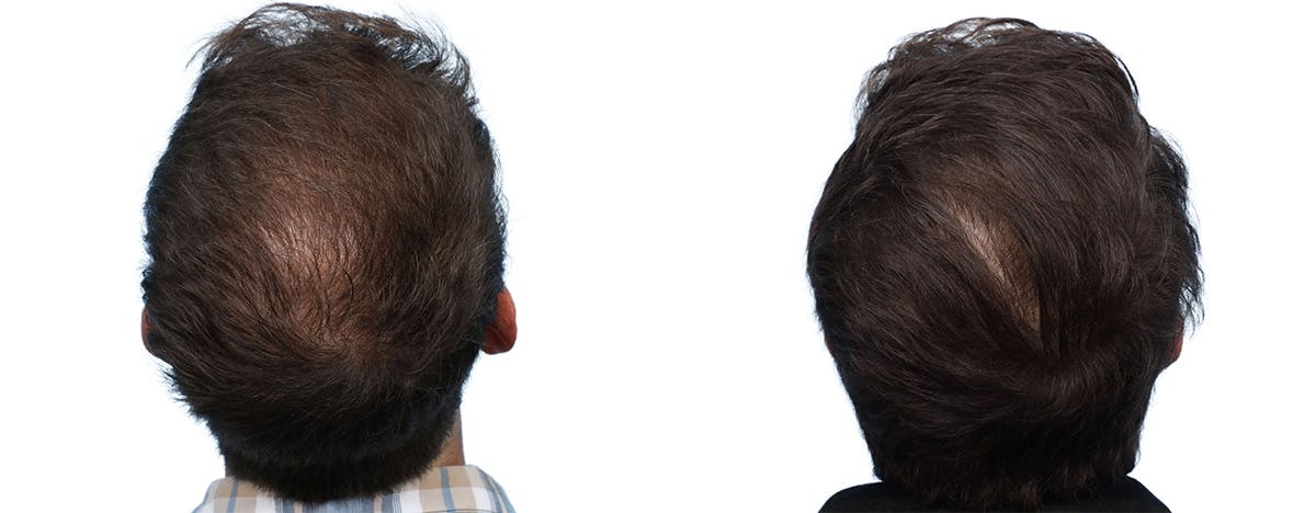 FUE Hair Transplant Before & After Gallery - Patient 236051 - Image 3