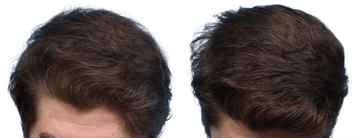 FUE Hair Transplant Before & After Gallery - Patient 236051 - Image 2