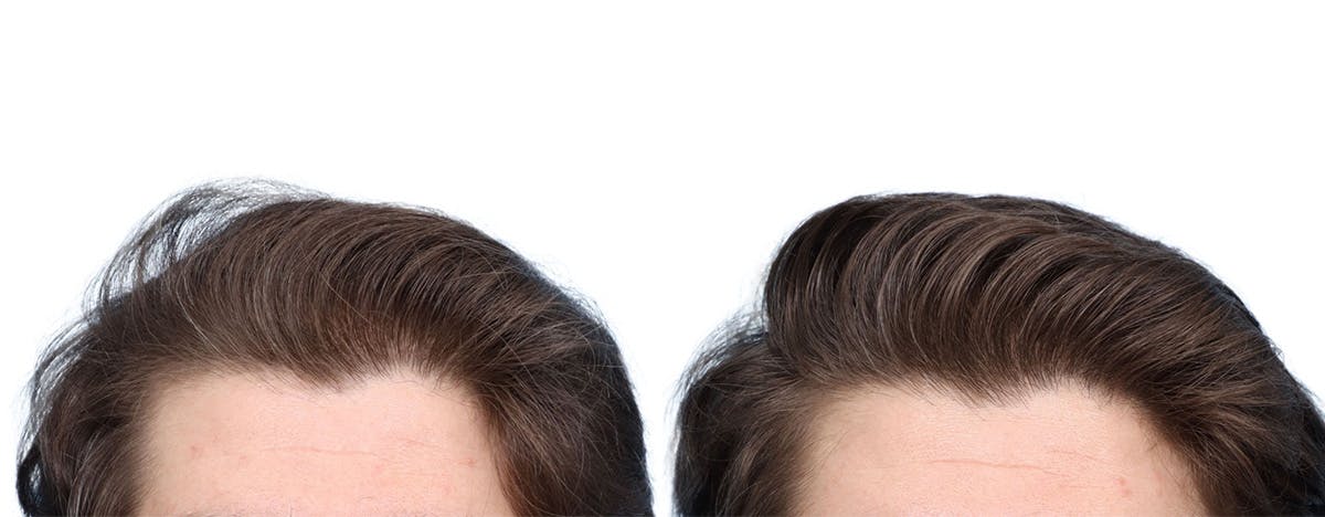 FUE Hair Transplant Before & After Gallery - Patient 236051 - Image 1