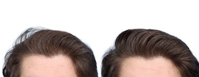 FUE Hair Transplant Before & After Gallery - Patient 236051 - Image 1