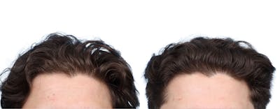 Platelet-Rich-Plasma Before & After Gallery - Patient 971380 - Image 1
