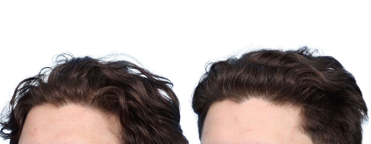 Platelet-Rich-Plasma Before & After Gallery - Patient 971380 - Image 2