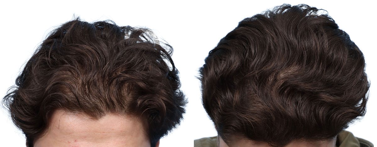 Platelet-Rich-Plasma Before & After Gallery - Patient 971380 - Image 3
