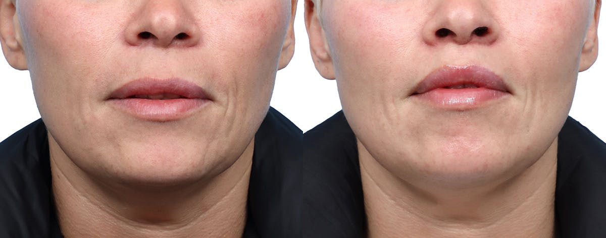 Lip Lift Before & After Gallery - Patient 380092 - Image 1