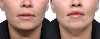 Lip Lift Before & After Gallery - Patient 380092 - Image 1