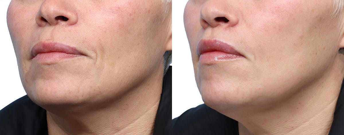 Lip Lift Before & After Gallery - Patient 380092 - Image 3