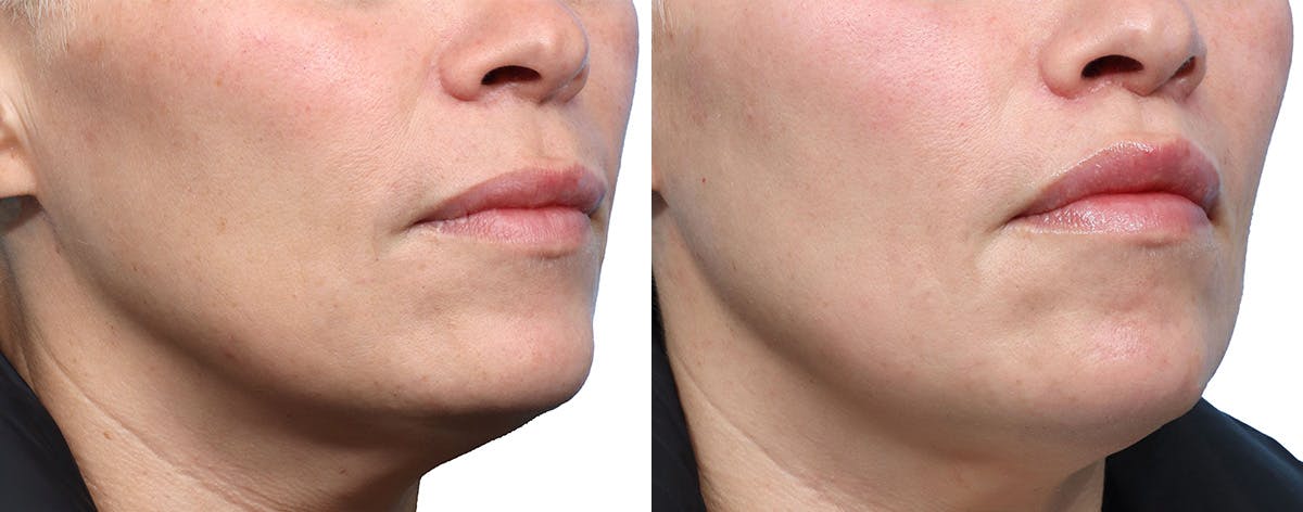 Lip Lift Before & After Gallery - Patient 380092 - Image 2