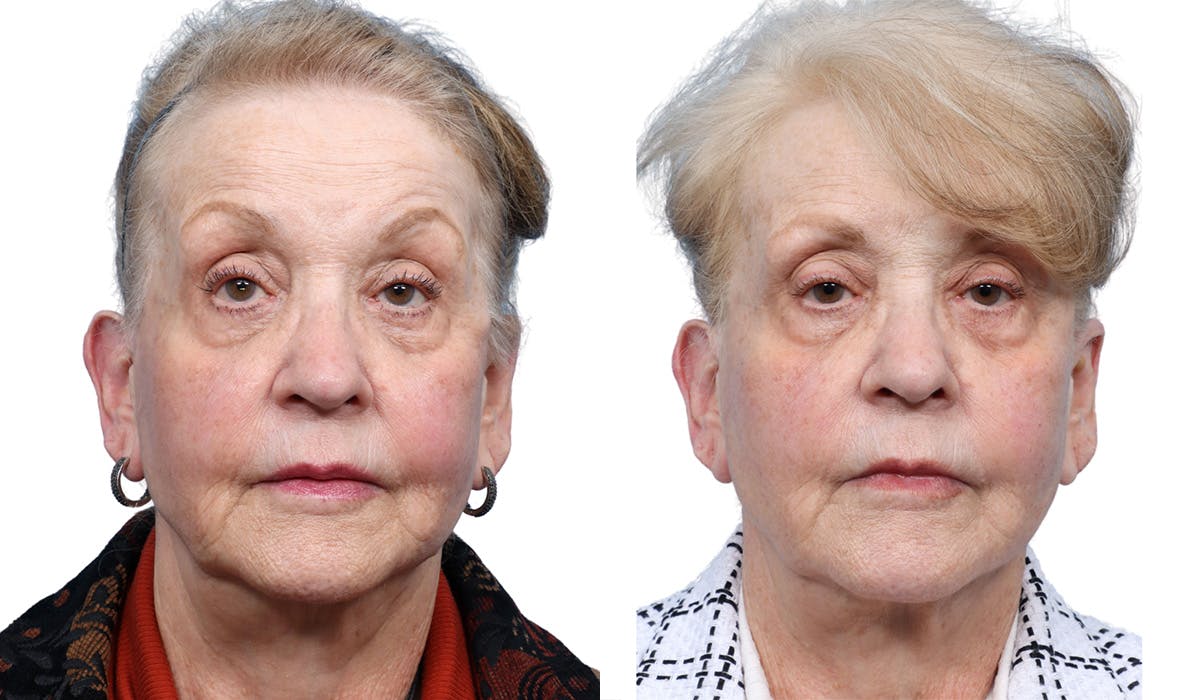 Ultherapy® Before & After Gallery - Patient 222139 - Image 1