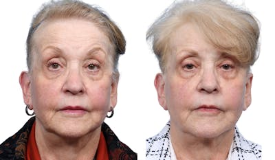 Ultherapy® Before & After Gallery - Patient 222139 - Image 1