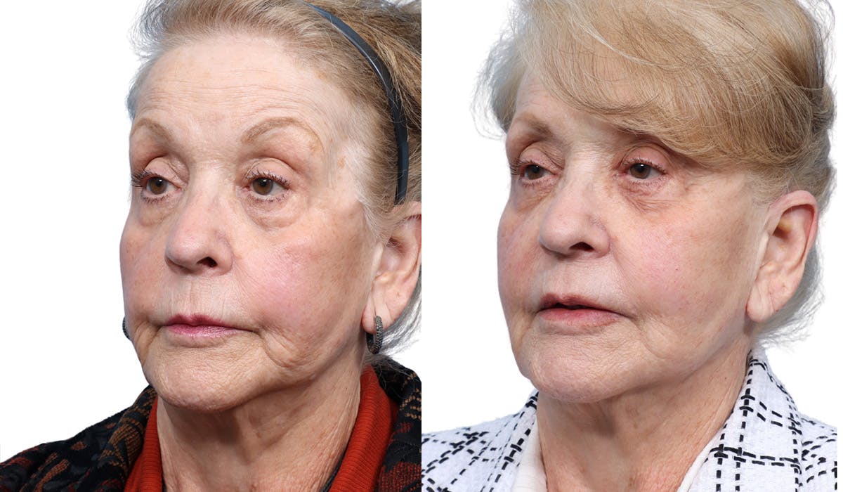 Ultherapy® Before & After Gallery - Patient 222139 - Image 2