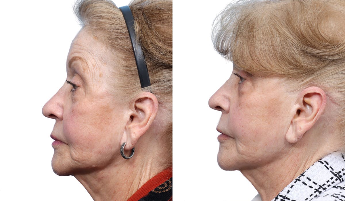 Ultherapy® Before & After Gallery - Patient 222139 - Image 3
