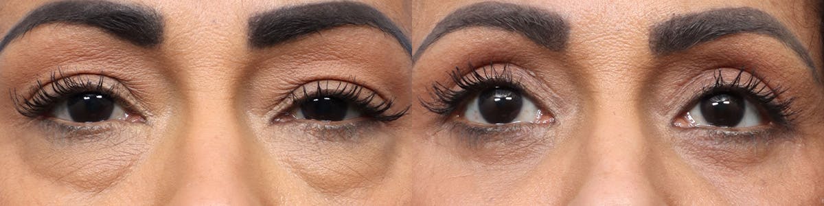 Blepharoplasty (Eyelid Surgery) Before & After Gallery - Patient 115123 - Image 1