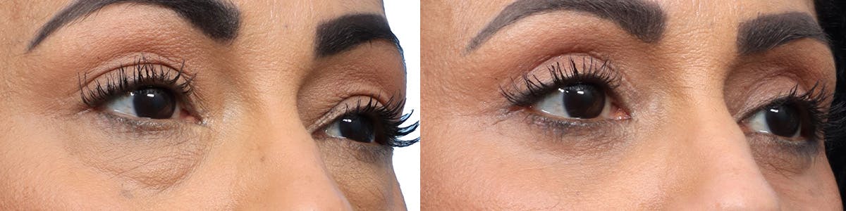 Blepharoplasty (Eyelid Surgery) Before & After Gallery - Patient 115123 - Image 2