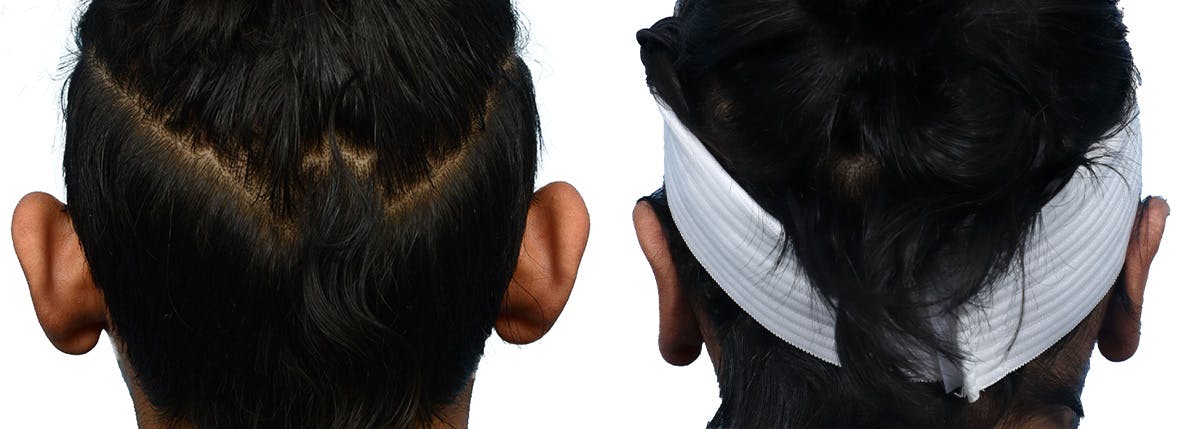 Otoplasty (Ear Surgery) Before & After Gallery - Patient 373165 - Image 2