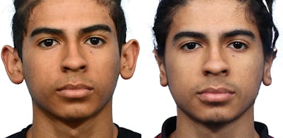 Otoplasty (Ear Surgery) Before & After Gallery - Patient 373165 - Image 1
