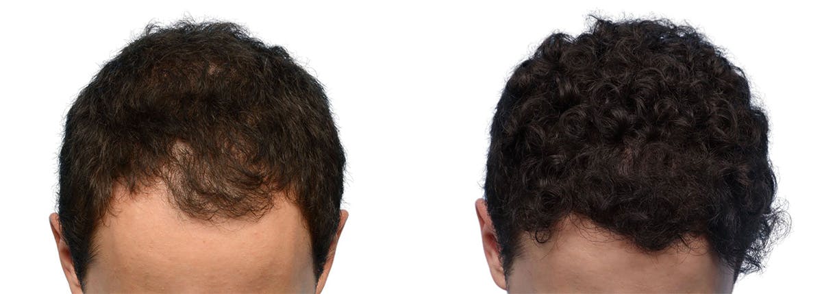 FUE Hair Transplant Before & After Gallery - Patient 129443 - Image 1