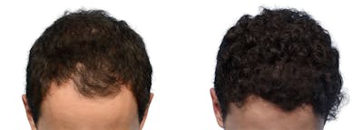 FUE Hair Transplant Before & After Gallery - Patient 129443 - Image 1