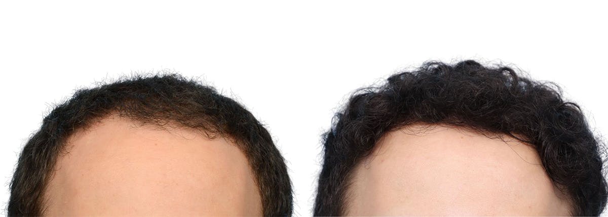 FUE Hair Transplant Before & After Gallery - Patient 129443 - Image 2