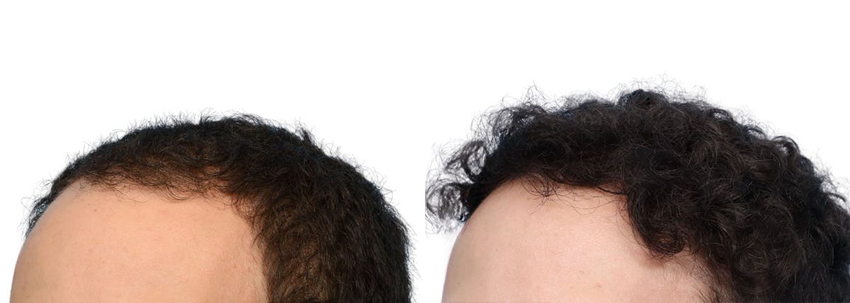 FUE Hair Transplant Before & After Gallery - Patient 129443 - Image 4
