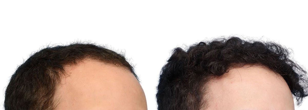 FUE Hair Transplant Before & After Gallery - Patient 129443 - Image 3