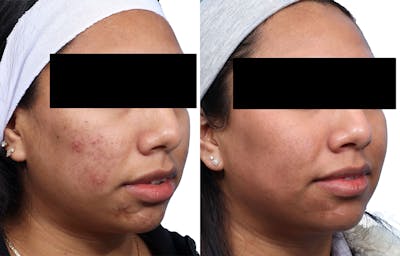 Skinpen Microneedling Before & After Gallery - Patient 853600 - Image 1