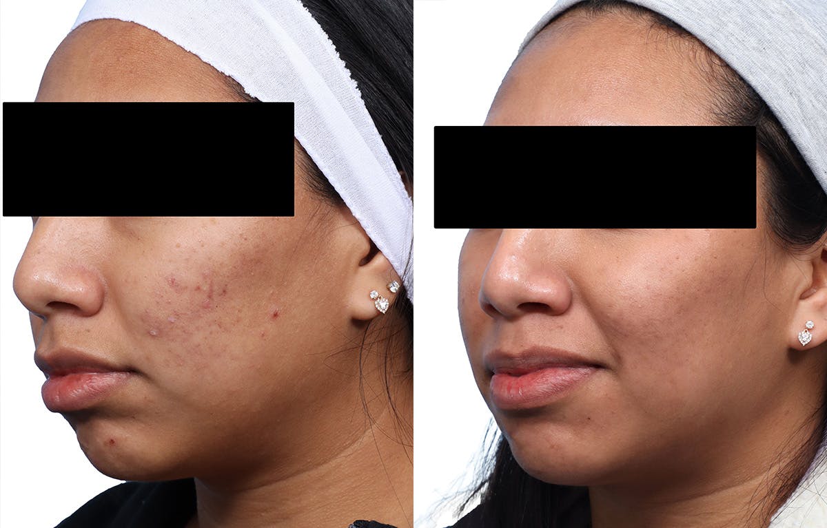 Skinpen Microneedling Before & After Gallery - Patient 853600 - Image 3