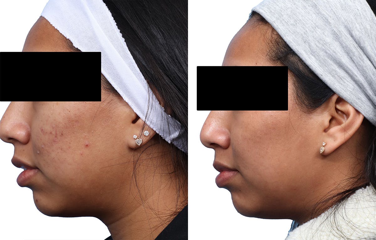 Skinpen Microneedling Before & After Gallery - Patient 853600 - Image 4