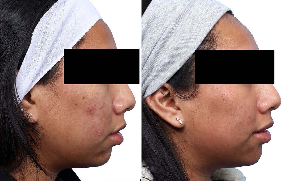 Skinpen Microneedling Before & After Gallery - Patient 853600 - Image 2