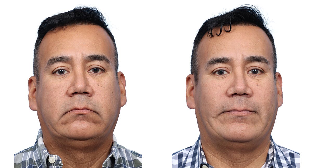 Chin Augmentation Before & After Gallery - Patient 124737 - Image 2