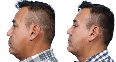 Chin Augmentation Before & After Gallery - Patient 124737 - Image 1