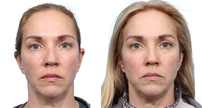 VBeam® Before & After Gallery - Patient 258515 - Image 1