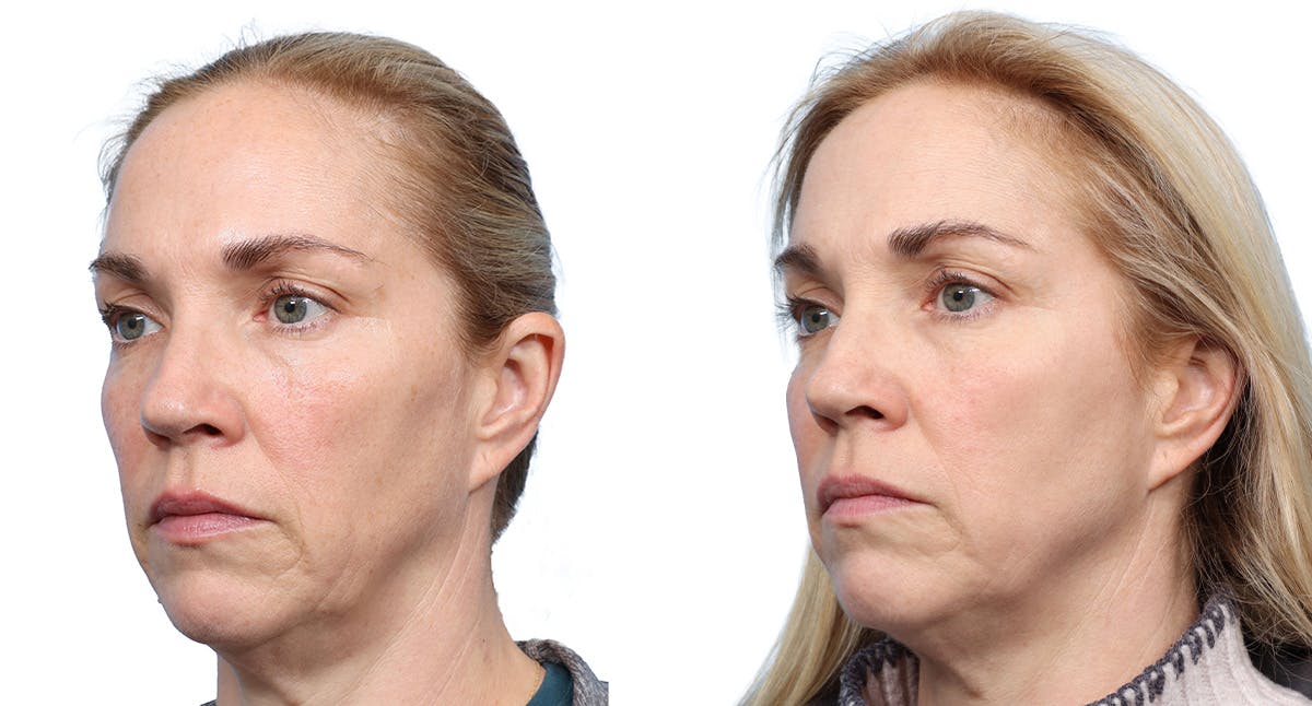 Lutronic Ultra Before & After Gallery - Patient 236590 - Image 3