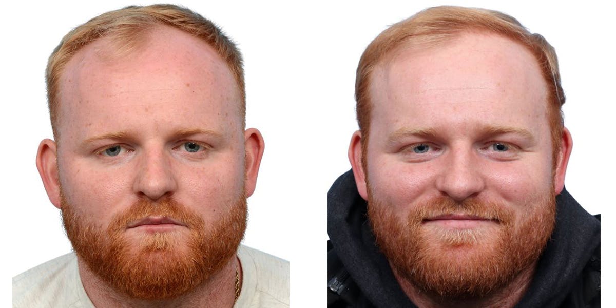 FUE Hair Transplant Before & After Gallery - Patient 160744 - Image 1